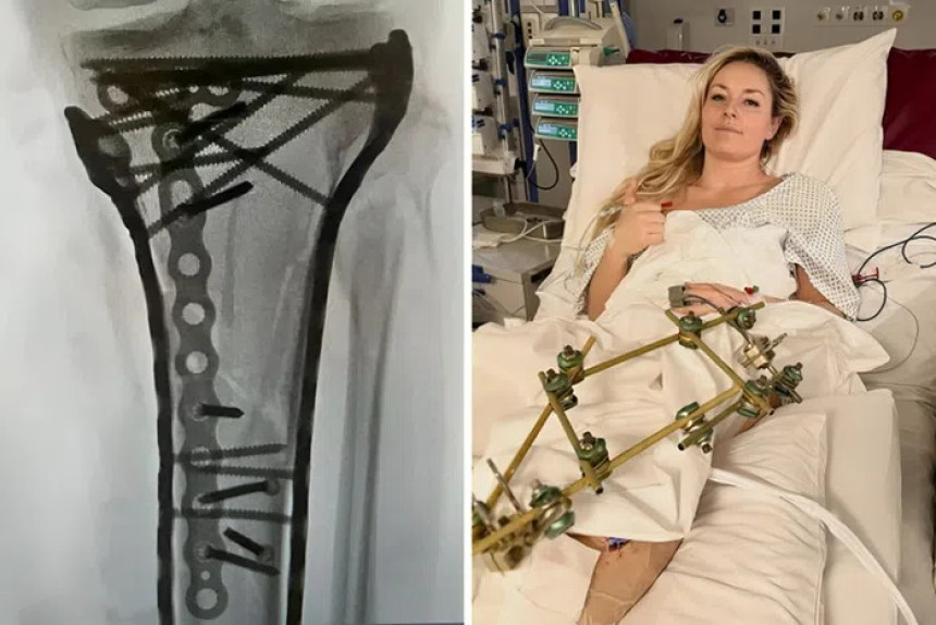 Шраф до шрафа: Овако сада изгледа нога Линдзи Вон (ВИДЕО)