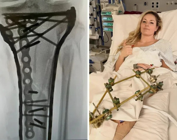 Šraf do šrafa: Ovako sada izgleda noga Lindzi Von (VIDEO)