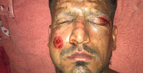 Fudbaler se unakazio vatrometom!