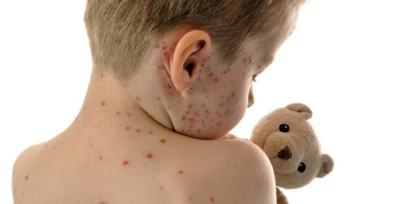 Šesta žrtva malih boginja u Srbiji 