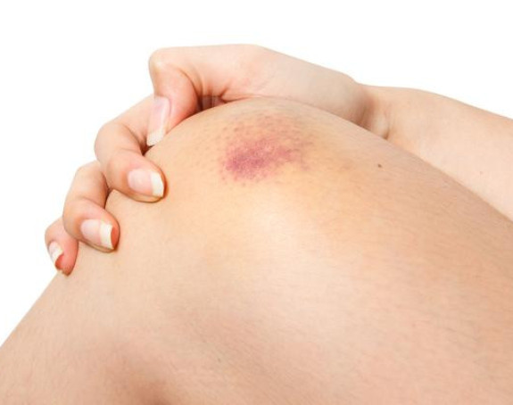 Oblik i boja modrice mnogo "govore"