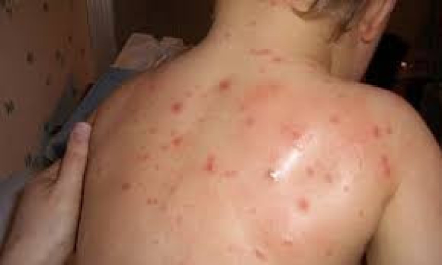U Banjaluci epidemija morbila