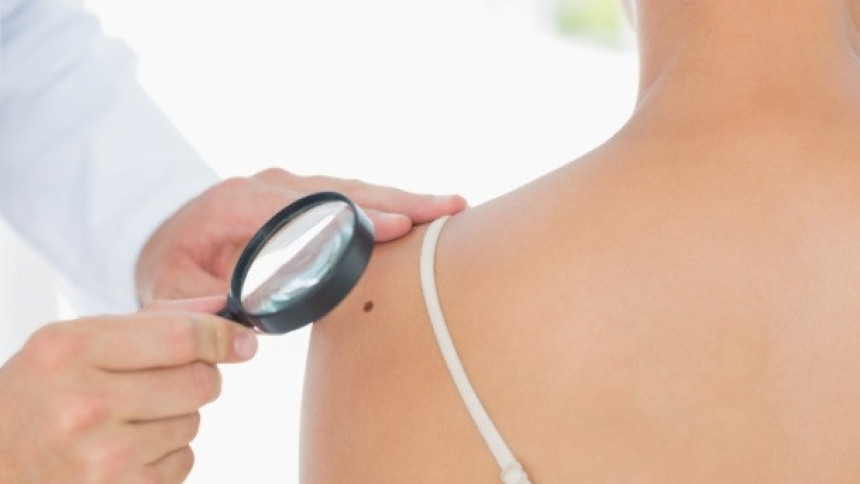 Kada promjene na koži mogu da ukažu na melanom?