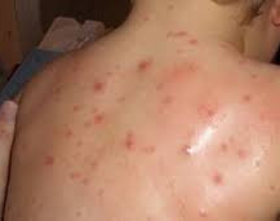 Epidemija morbila u Banjaluci