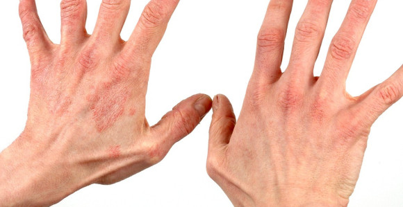 Liječenje psorijaze na prirodan način