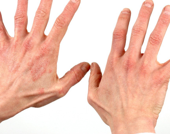 Liječenje psorijaze na prirodan način