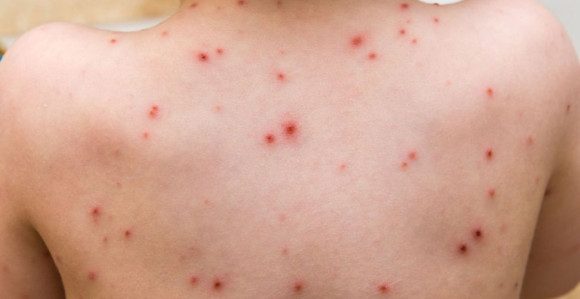 Treće dijete umrlo od boginja 