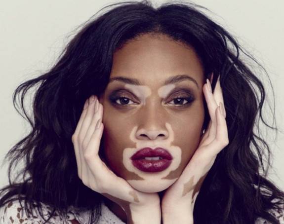 Ne postoji lijek koji će vratiti pigment kod vitiliga