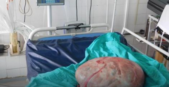 Banjaluka: Odstranili tumor težak 31 kg!