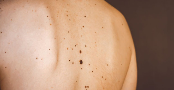 Krupni mladeži stoje na putu starenju