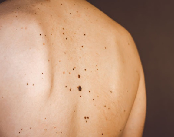 Krupni mladeži stoje na putu starenju