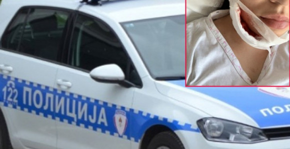 Djevojci čašom polomio vilicu 