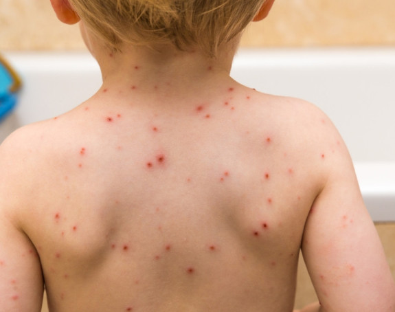 BG: Epidemija       malih boginja 