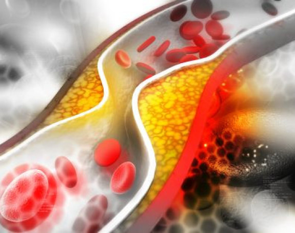 Naslage ispod očiju ukazuju na povišen holesterol