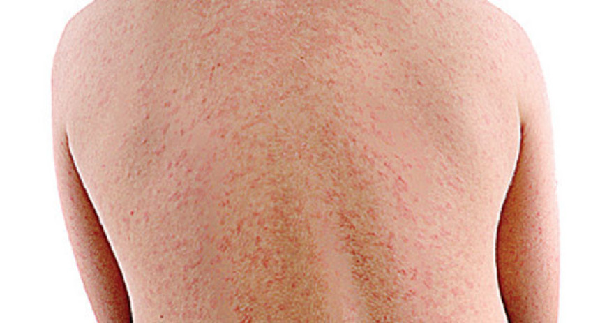 Banjalučanin zaražen morbilom 