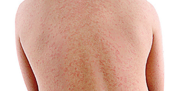 Banjalučanin zaražen morbilom 