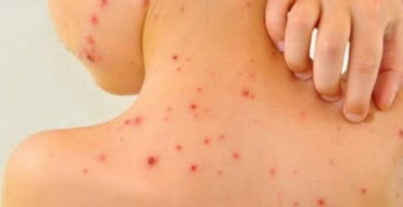 Morbile dobila još jedna osoba