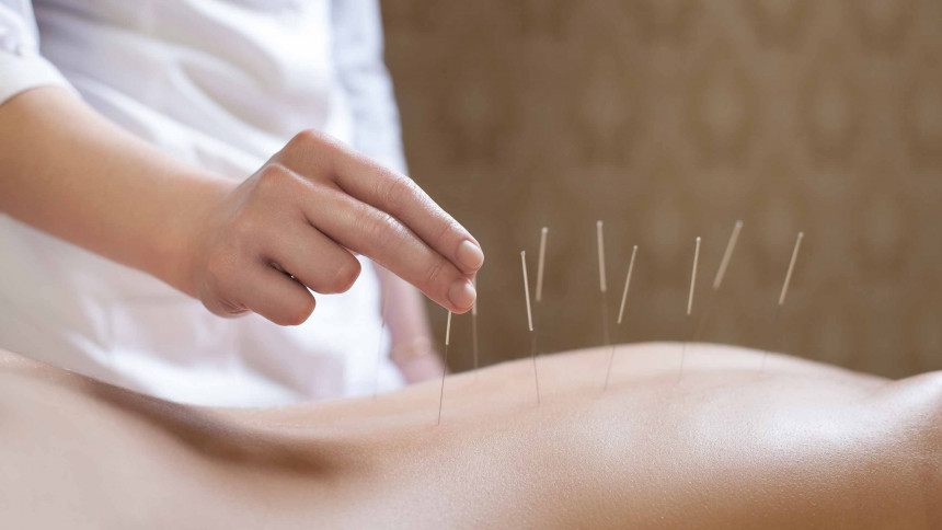 Akupunktura dobra protiv bolesti ?