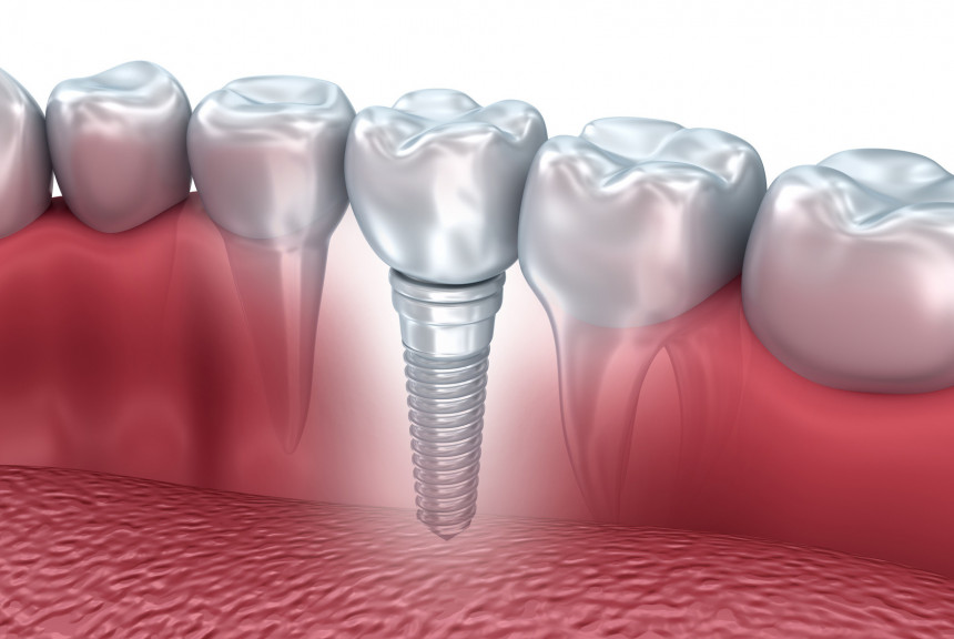 Sve o zubnim implantatima