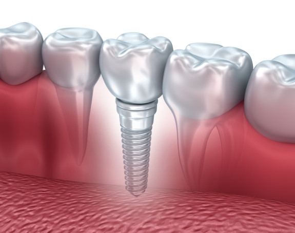 Sve o zubnim implantatima