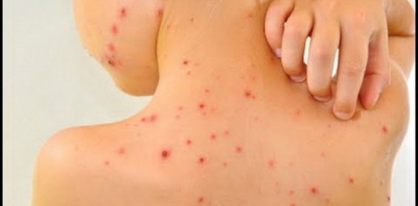 Epidemija morbila u dijelovima RS