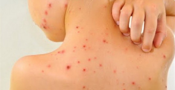 Epidemija morbila u dijelovima RS
