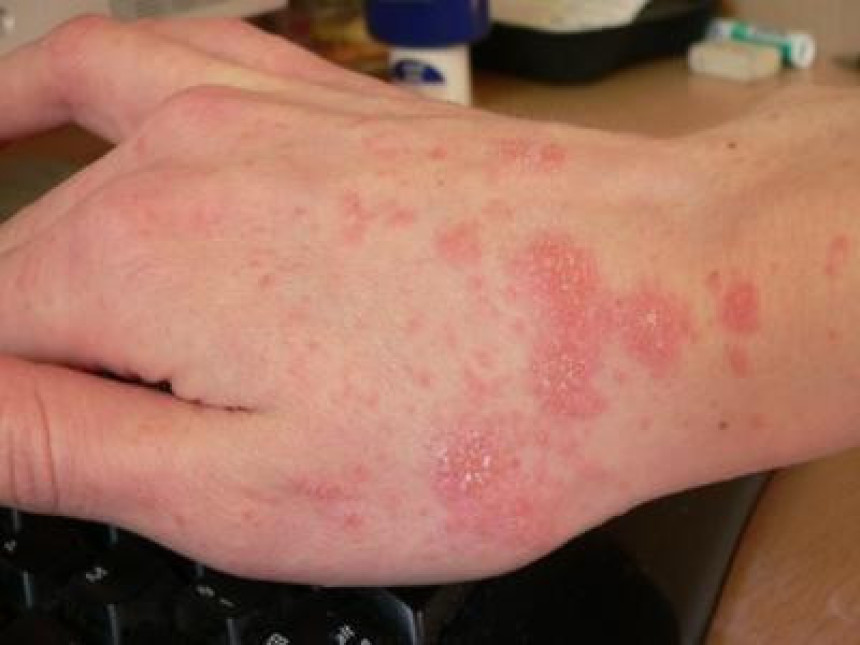 U porastu broj oboljelih od šuge