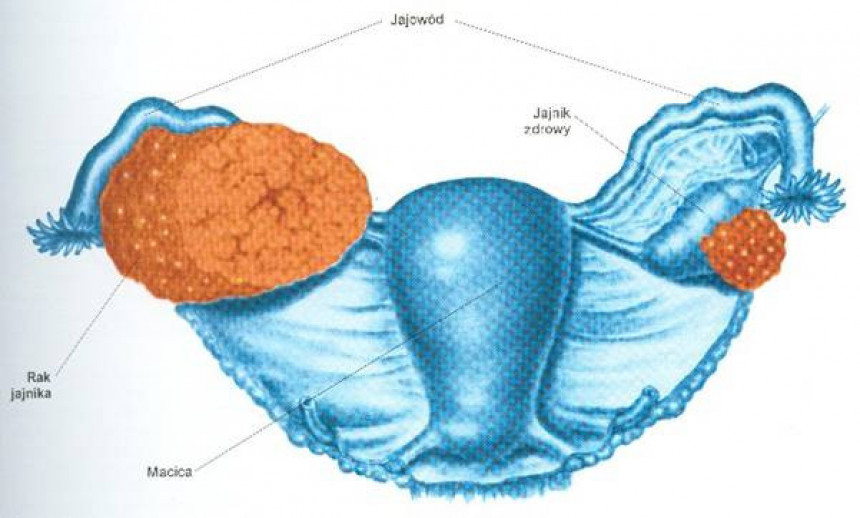 Rak jajnika otkrivamo tek u trećoj fazi 