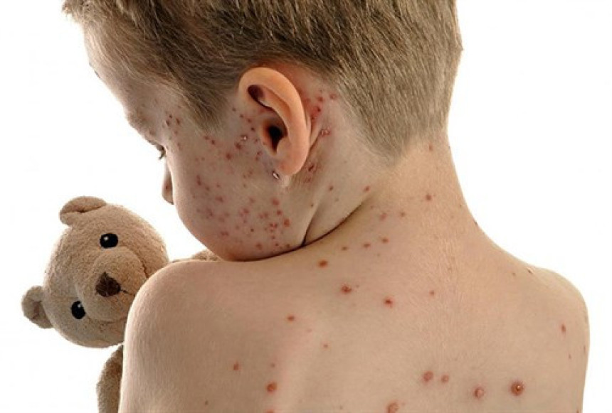 Bijeljina:Više od 900 slučajeva malih boginja