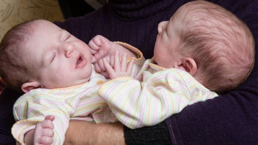 Келн: Љекари раздвојили сијамске близанце