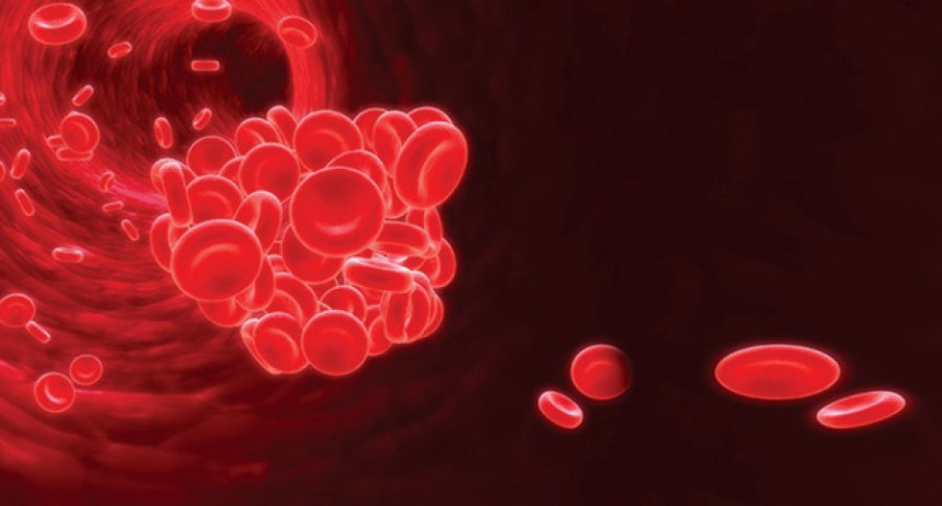 Kako da spriječite nastanak tromba