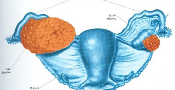 Rak jajnika otkrivamo tek u trećoj fazi 