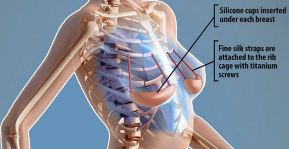 Pogledajte zahvat ugradnje "unutrašnjeg" brushaltera