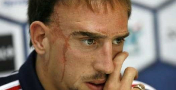 Riberi: Zvali su me ''Kvazimodo''!