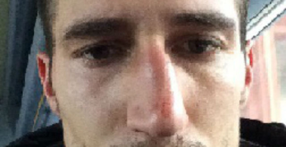 Turci Raći slomili nos!