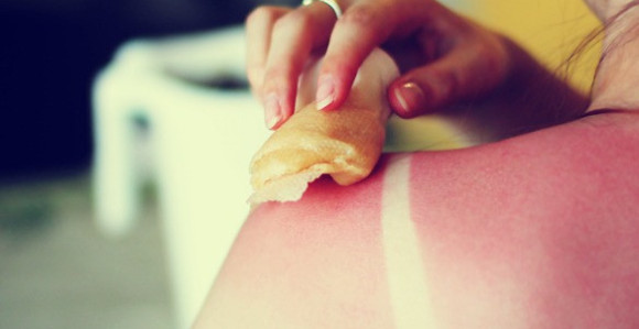 Ovo su najbolji domaći lijekovi za opekotine