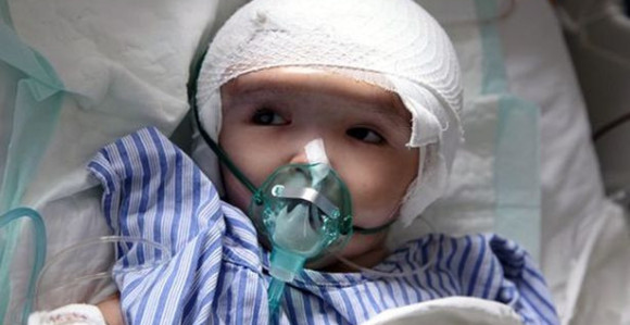 Dobila novu lobanju zahvaljujući 3D štampaču