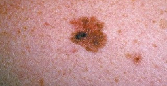 Podrška kampanji Evromelanoma u BiH