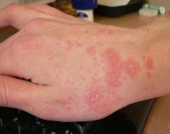 U porastu broj oboljelih od šuge