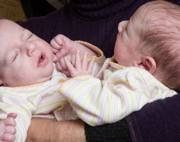Келн: Љекари раздвојили сијамске близанце