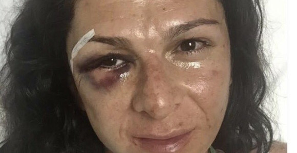 Бивша свјетска шампионка брутално претучена!