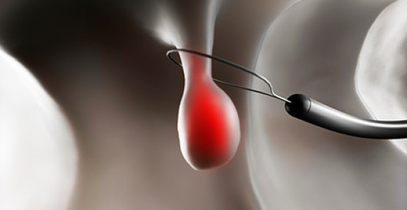 Polip treba da se operiše