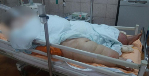 Живот о концу жене од 300 кг 