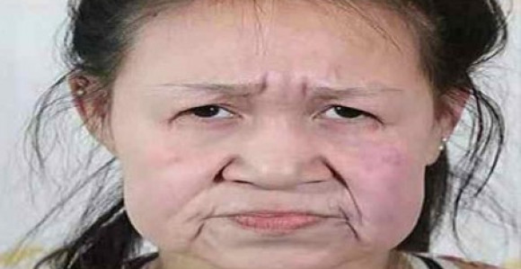 Sa 15 godina imala je lice starice a sada kao prava tinejdžerka!