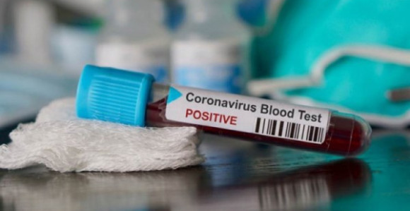 Cijela porodica iz Viteza zaražena na virus koorna