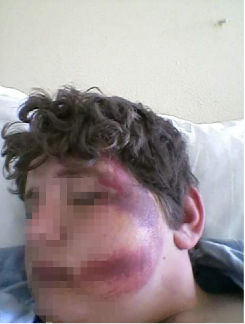 Povrede nastale tokom izvođenja radova na njivi