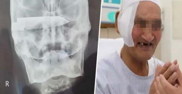 ŠOKANTNO: 26 godina živeo sa oštricom noža u glavi!