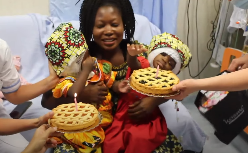 Sijamske bliznakinje uspešno razdvojene!