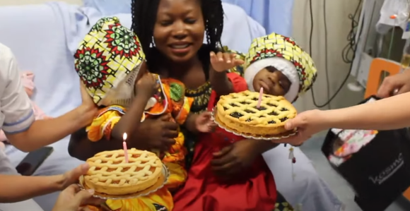 Sijamske bliznakinje uspešno razdvojene!