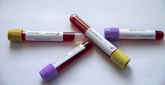 U distriktu Brčko još 30 zaraženih osoba